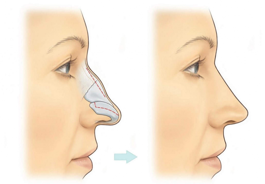 Как визуально уменьшить нос в домашних условиях ❤️ ANACOSMA