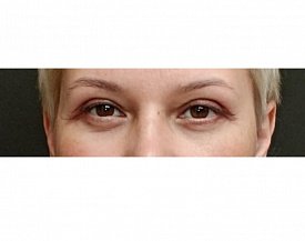блефаропластика 40