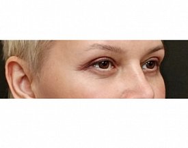 блефаропластика 43